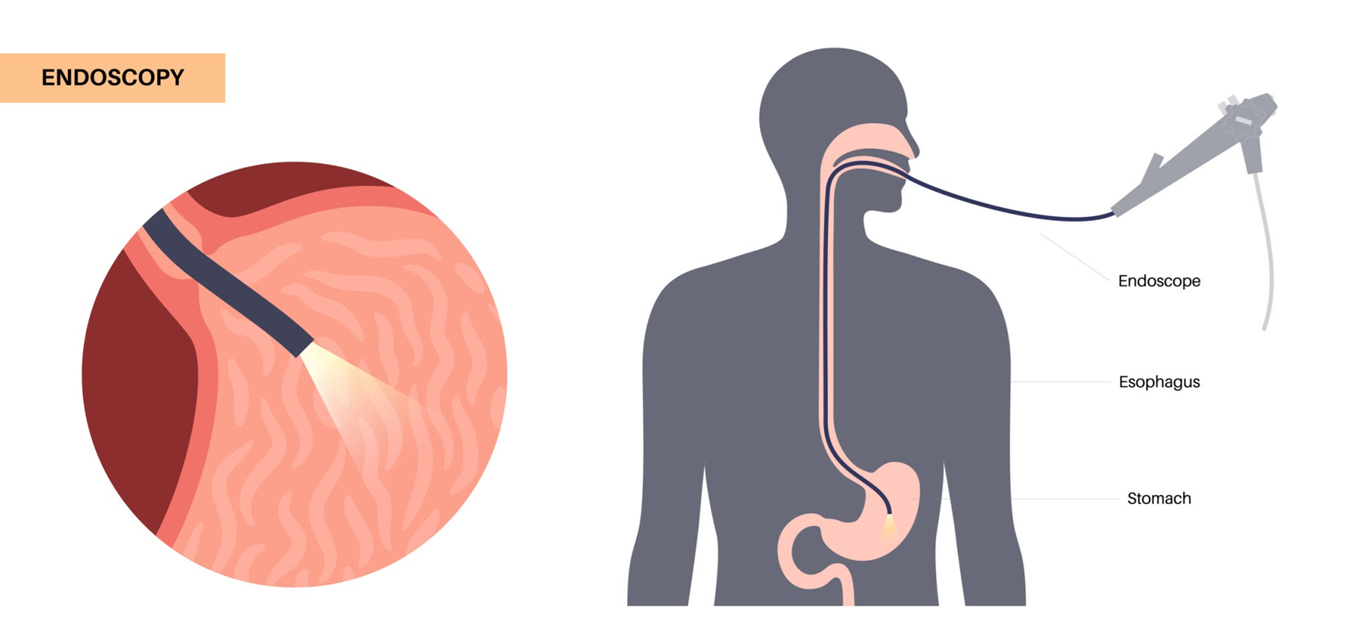 How is GERD Diagnosed